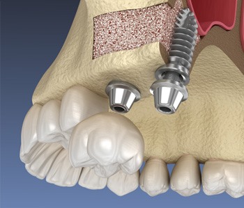 a 3D render of a dental bone graft procedure