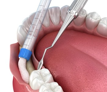 a 3D illustration of ridge expansion surgery