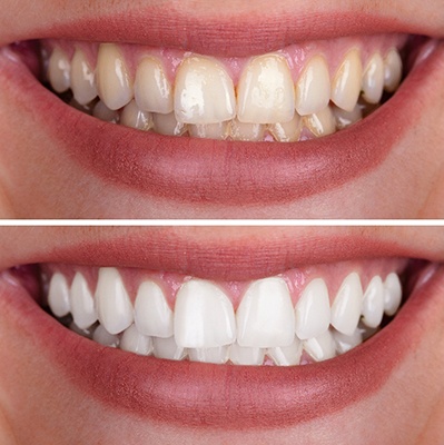 Closeup of patient's smile before and after teeth whitening